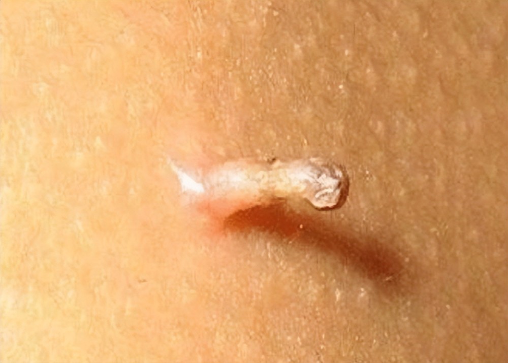皮赘怎么治疗 腾讯网