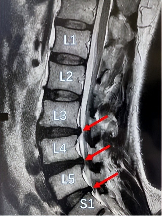 像朱先生的腰椎l1/l2,l2/l3椎
