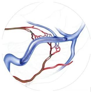 明察秋毫见微知著记北京老年医院首例硬脑膜动静脉瘘栓塞术