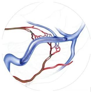 明察秋毫,見微知著:記北京老年醫院首例硬腦膜動靜脈瘻栓塞術