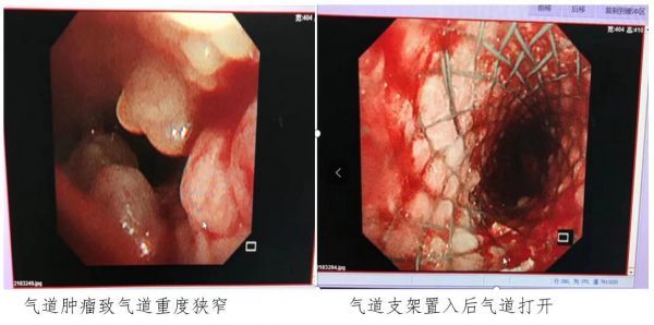 惡性中心氣道狹窄是指氣管,隆突,左右主支氣管及中間段支氣管因原發或