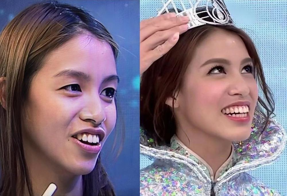 龅牙港姐夺冠史:海选免试,比赛为她开美颜,最后为何惨淡收场?