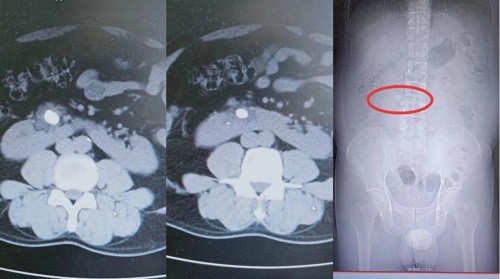 常德二医完成首例蹄铁形肾结石患者经皮肾镜联合输尿管软镜下碎石取石