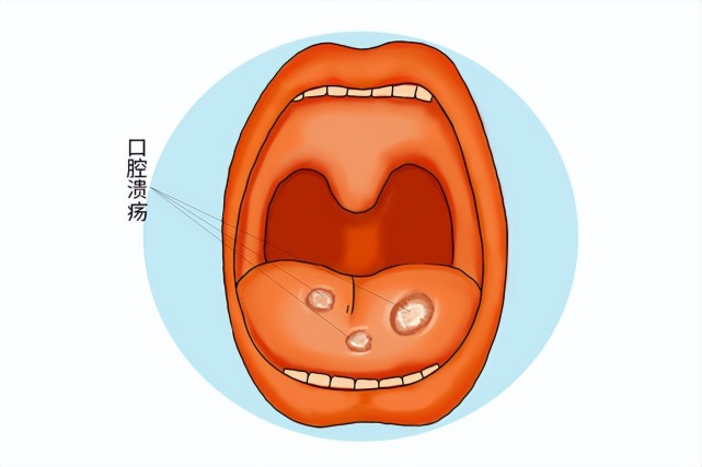 体内有癌,嘴巴4个症状很明显,发现2个以上尽早检查,不能大意