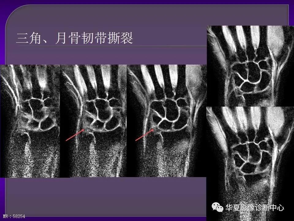 詳細解讀:腕關節解剖及常見病變mri表現_騰訊新聞