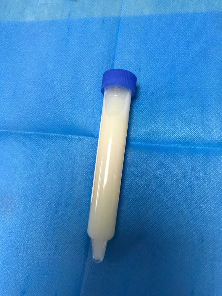 湖南六旬男子解出牛奶尿竟是这个原因