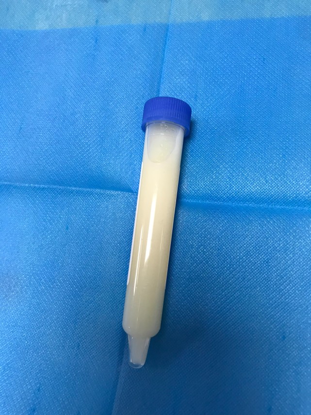 湖南六旬男子解出"牛奶"尿,竟是这个原因|尿液|乳糜尿|杨科|丝虫|牛奶