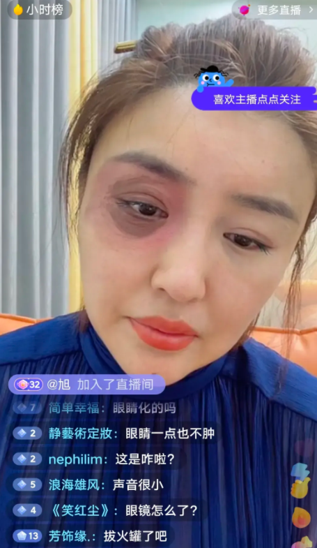 不得不说,娇娇的前夫下手够狠:娇娇的右眼睛都被打到红肿.