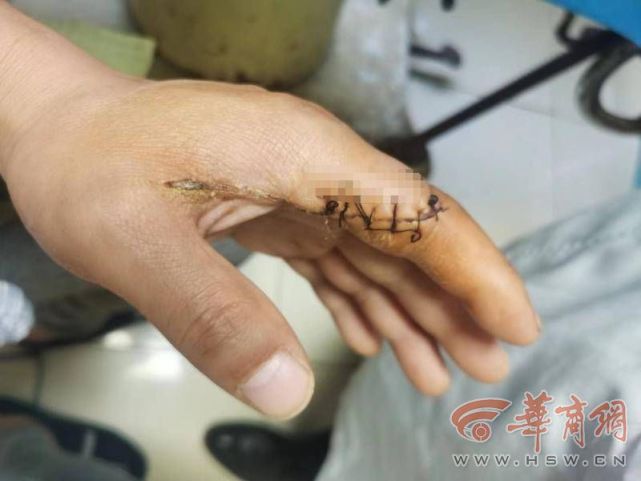 被工友叫去干活手指受伤致十级伤残因未签订劳动合同赔偿成问题