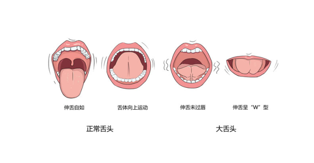 被人嘲笑大舌頭只能剪舌繫帶嗎,說話不清楚真的是舌頭的問題嗎