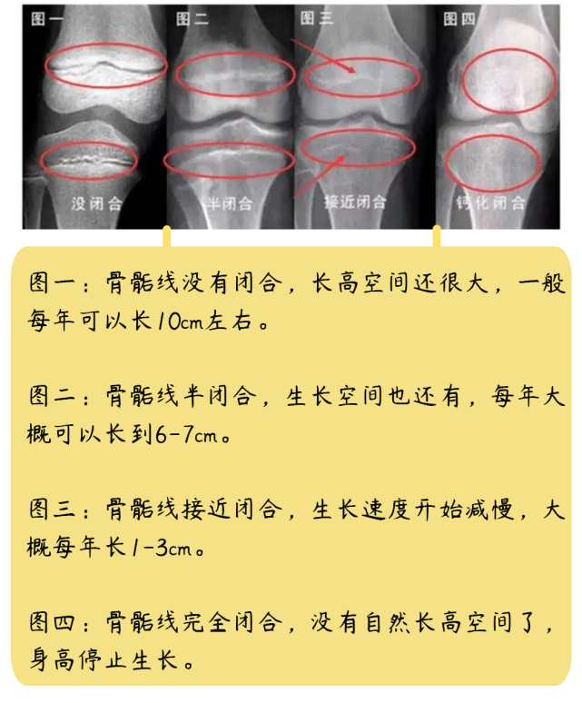 性早熟孩子的骨骼會進入快速增長階段,因此,他們的骨骺線閉合會更早