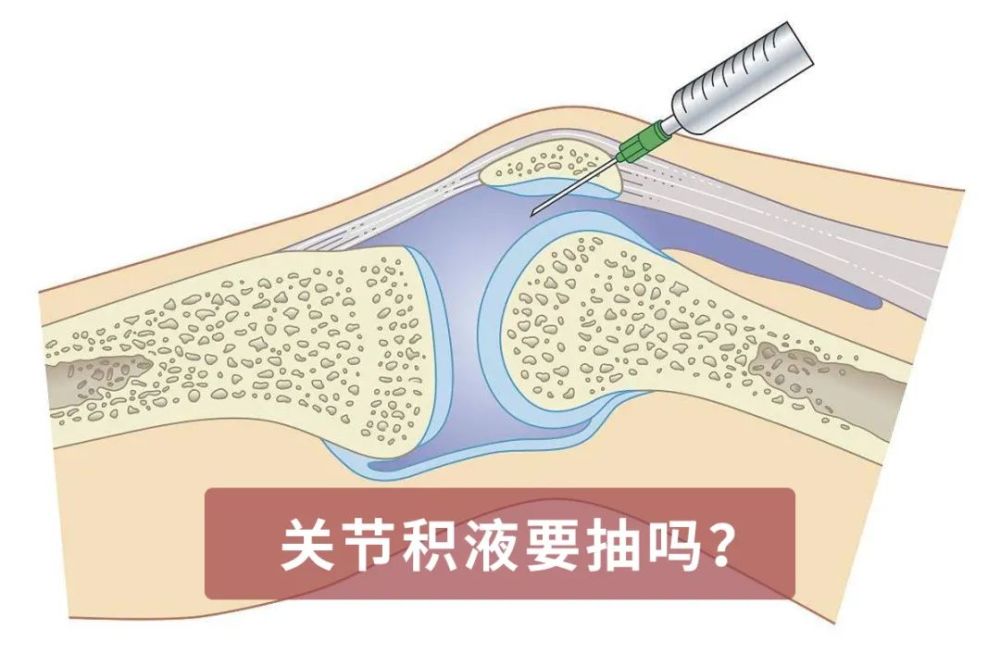 成都治療膝蓋積液好的醫院老年人膝關節積液要找準原因只抽積液小心抽