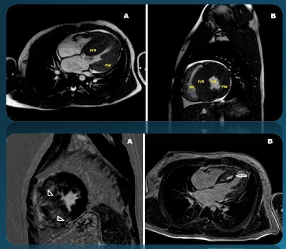 【才俊讲堂】孔令秋:左心室肥厚的诊断方法