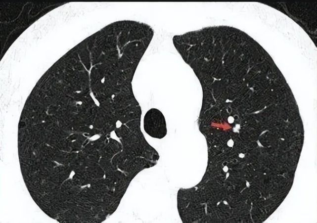 查出肺结节4mm,医生让观察,几年都没变化还需要观察吗?