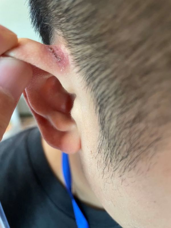 桂福耳朵被口罩勒出的伤痕桂福在核酸实验室从事信息录入,核酸提取