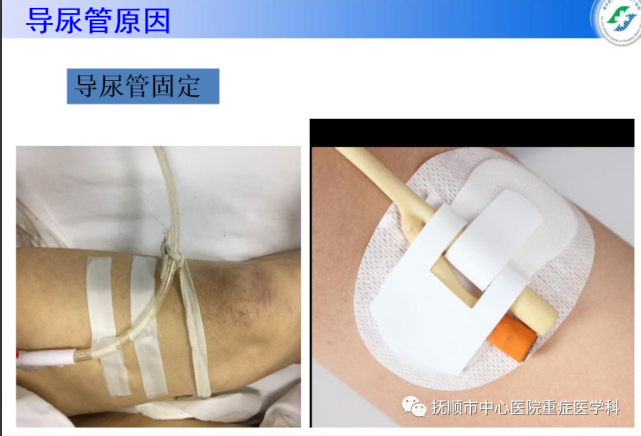 【ppt】常见留置导尿患者漏尿的原因