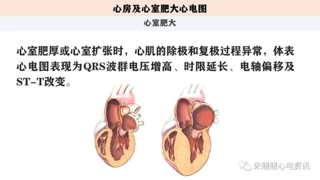 心电图解读第五讲:心房及心室肥大心电图(ppt)