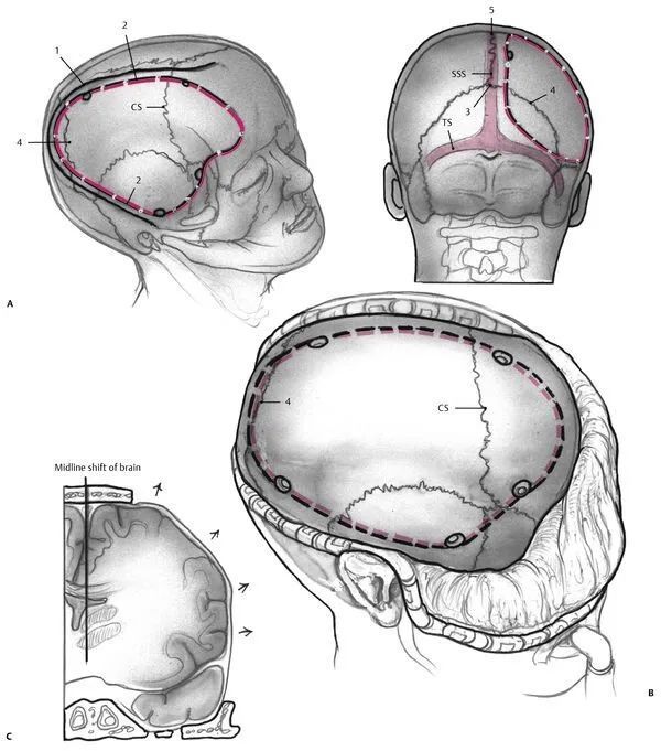thieme|去骨瓣减压术图解_腾讯新闻