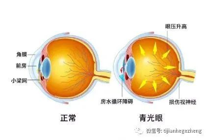 现役飞行员发现青光眼会被停飞吗