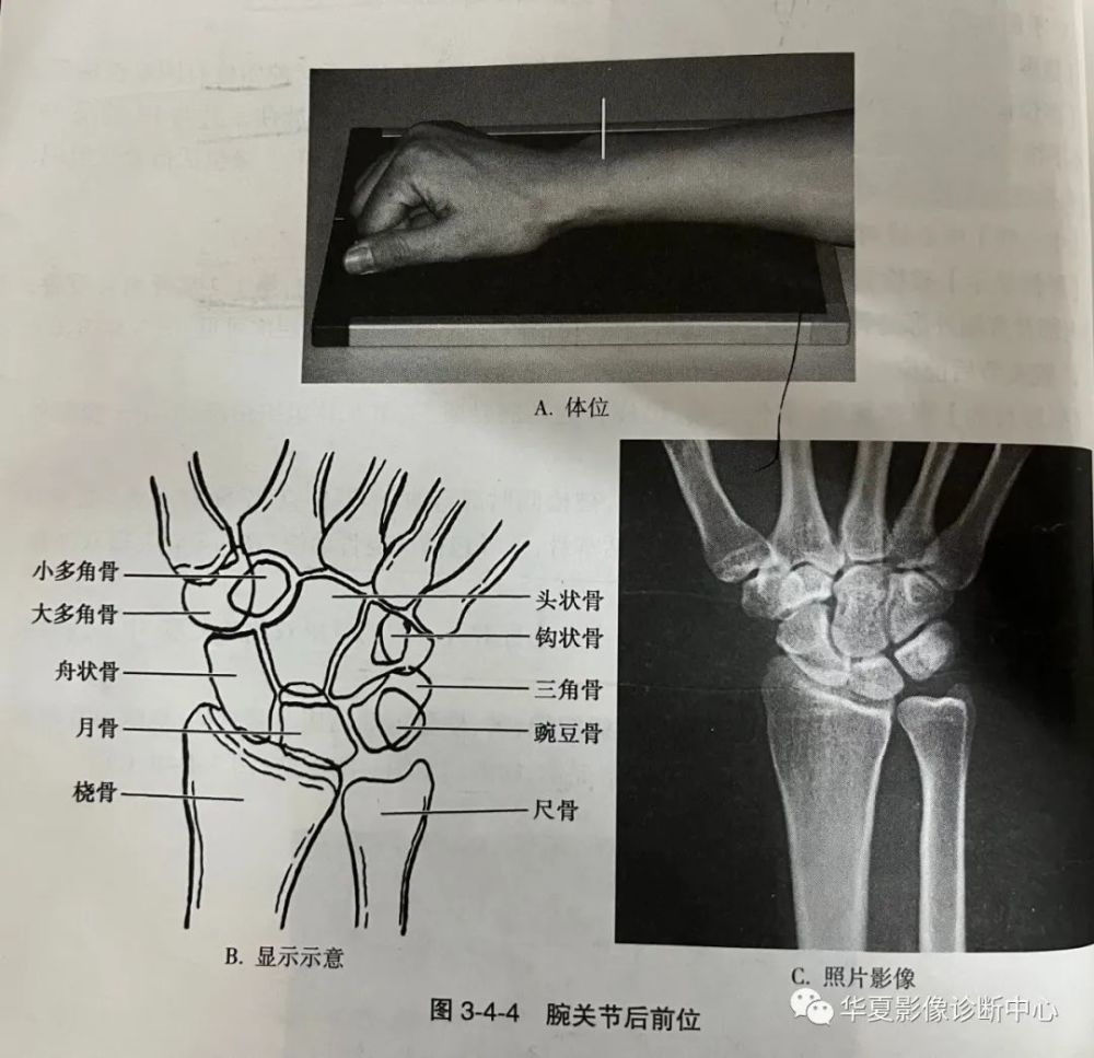 腕关节侧位【摄影目的】观察腕骨,掌骨近端,尺桡骨远端的骨质,关节及