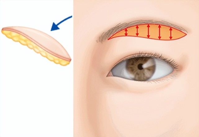 專家告訴你～提眉手術有什麼風險,提眉後為什麼眼窩凹陷?