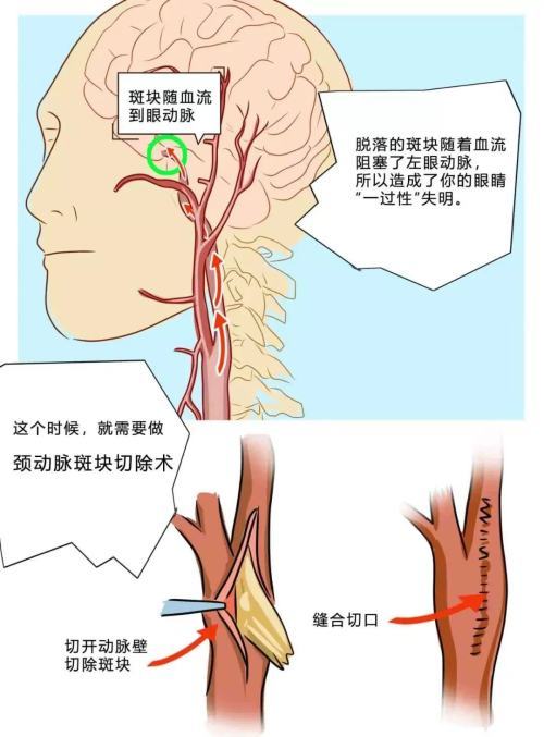 腦梗等腦血管疾病原來和頸動脈斑塊有關,兩分鐘學習起來_騰訊新聞