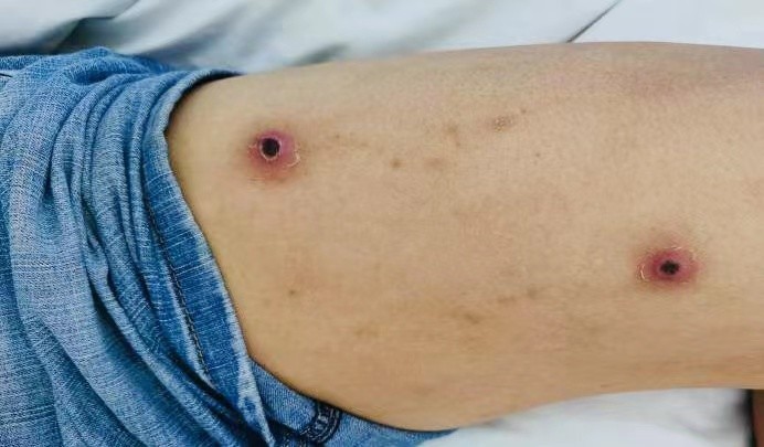 恙虫病,又叫丛林斑疹伤寒,是由带有恙虫病立克次体的恙螨幼虫叮咬而