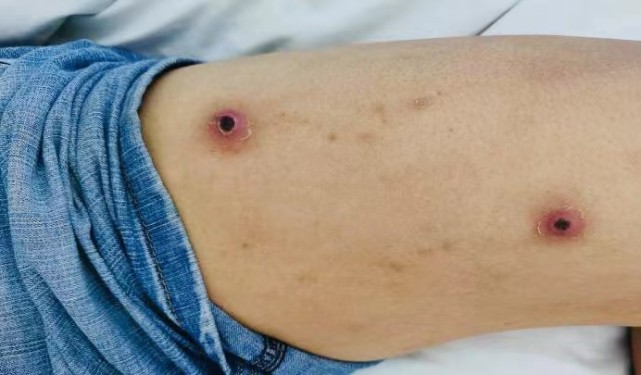 户外晨练后身上出现焦痂罪魁祸首竟是一只小虫