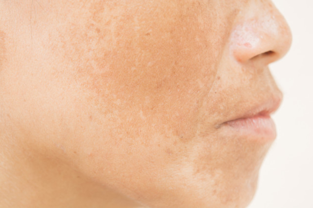 黄褐斑又称为妊娠斑,多出现在女性脸上,有调查显示,70%的女性在怀孕