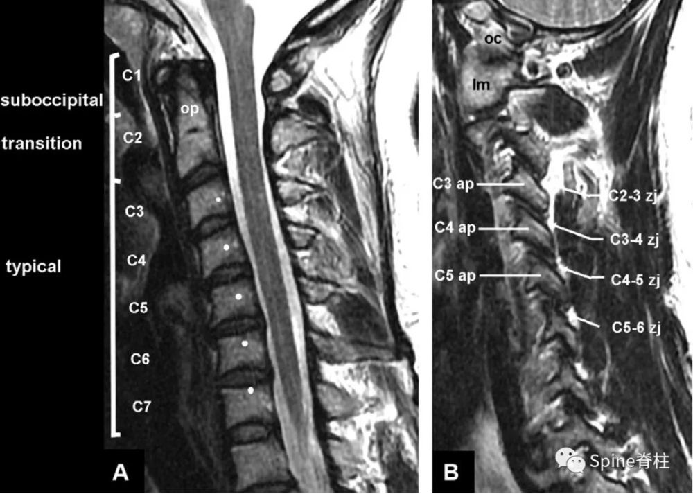 为了描述方便,学者bogduk教授将颈椎分为三个区域,枕下区(sub