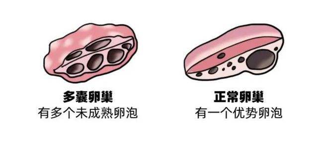 多囊卵巢綜合徵由於存在