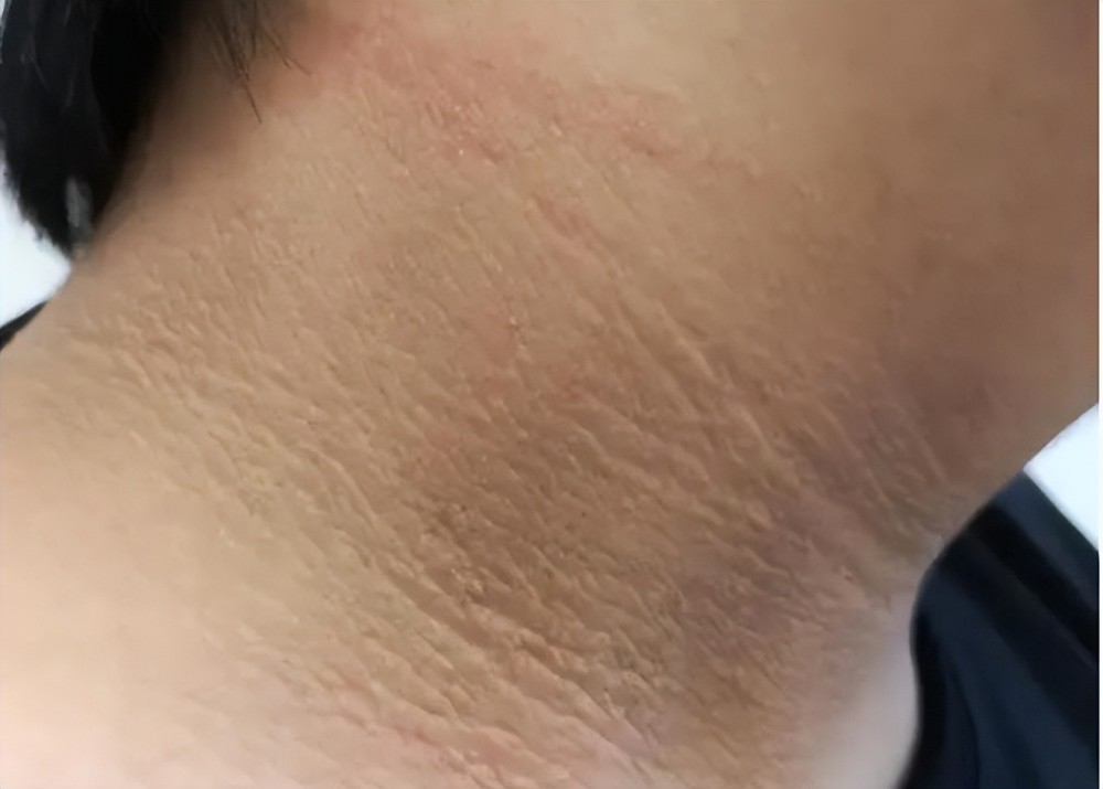 其实不然,黑棘皮病会出现皮肤色素的增加,皮肤肥厚以及角化过度,甚至