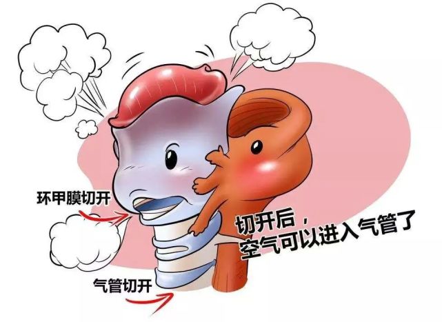 经过仔细全面地检查,发现这是一位急性会厌炎导致的喉头水肿患者,需
