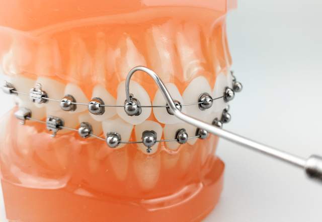 球面自锁托槽怎么样,圆润舒适易清洁是真的吗?