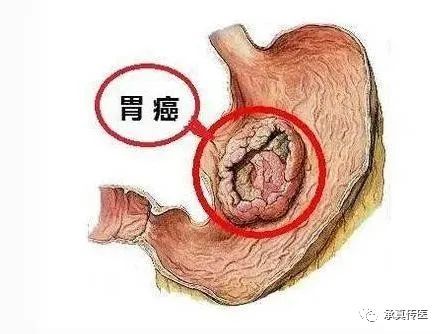 胃息肉腸息肉這個方子效果好