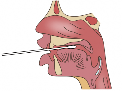 咽拭子捅的是兩側咽扁桃體以及咽後壁.