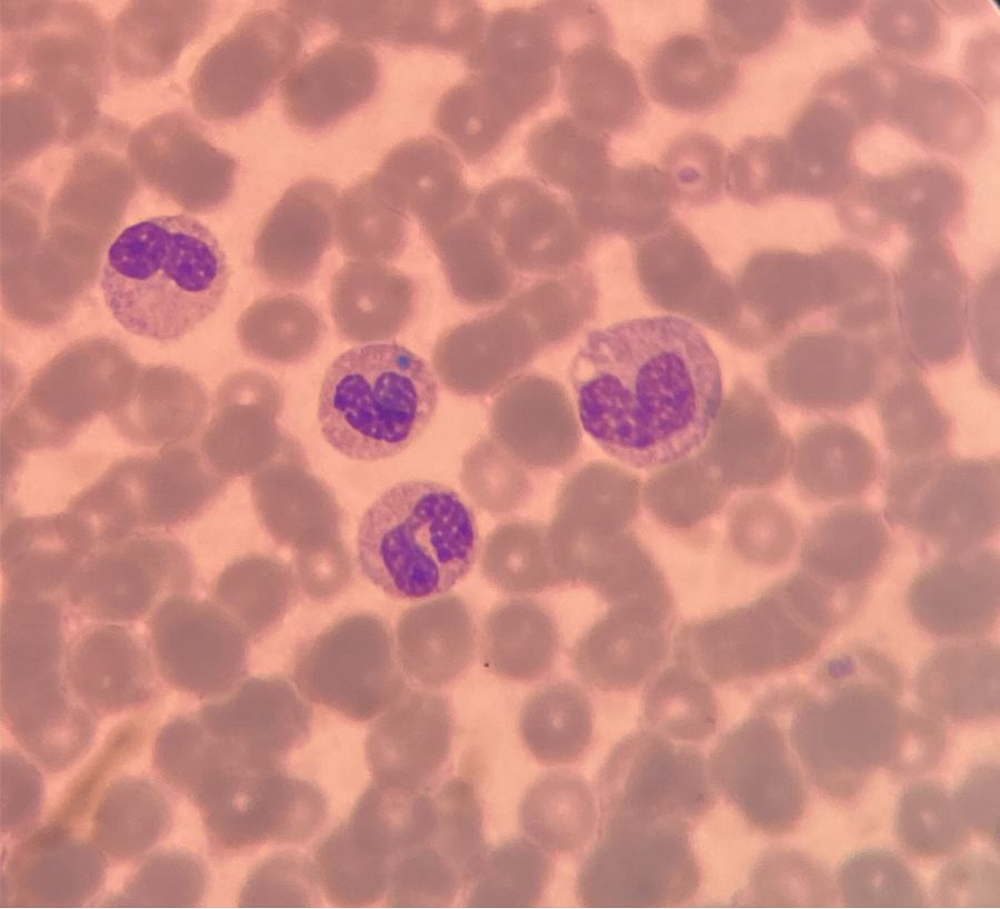 如下:于是人工复检,推片看镜下,细胞的分类也以中性杆状核粒细胞为主