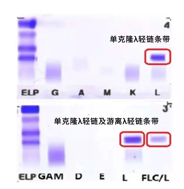 免疫固定电泳显示存在0.9%λ轻链型m带(图3.