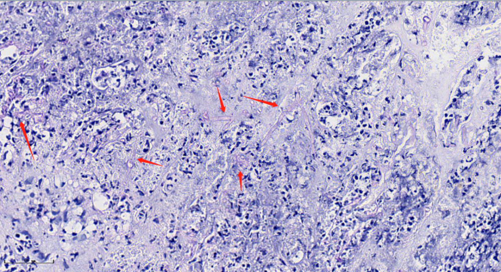 特染结果:pas染色( ),六胺银( )●   肾穿刺活检病原:可见较多无隔真