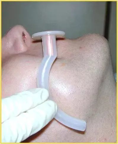 口咽通气管的使用方法图片