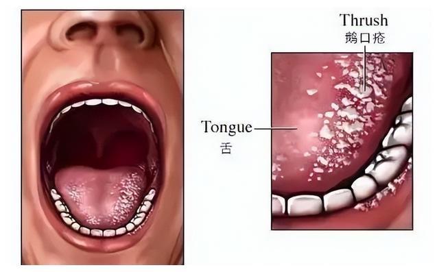 引发疼痛;),嘴里出现白膜,红斑,口角炎;鹅口疮(2)出现口腔真菌感染((1