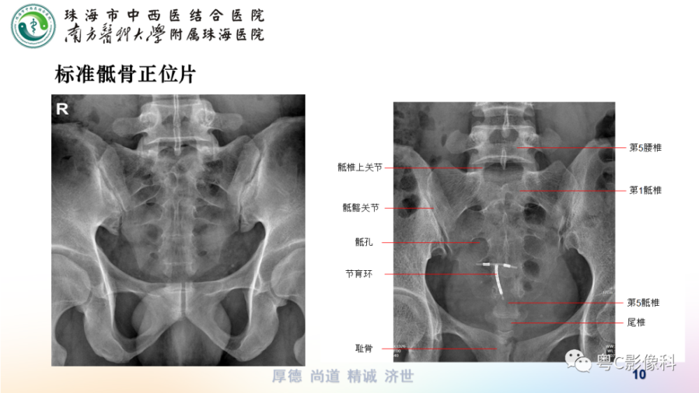 骶尾骨正側位x線攝影