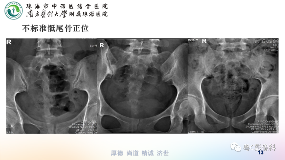 骶尾骨正側位x線攝影