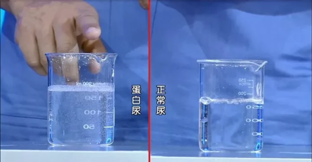 "身体水肿肾功能受到损害时,不能正常运行,引起水钠潴留而使面部和