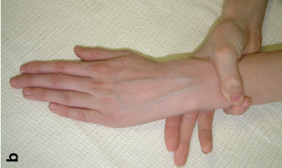 因为eds和马凡氏综合征都会影响到结缔组织,所以也会出现马凡氏综合