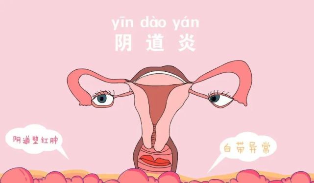 松子e生:妇科炎症对试管备孕的影响