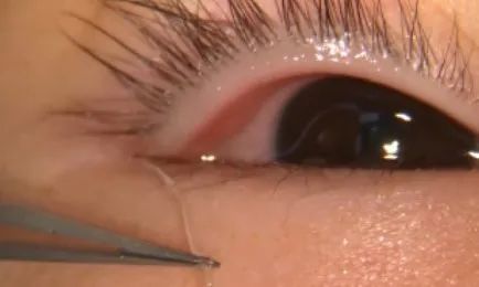 浙江10岁女孩眼睛里取出3条活虫竟是因为撸了流浪猫这几点一定要注意