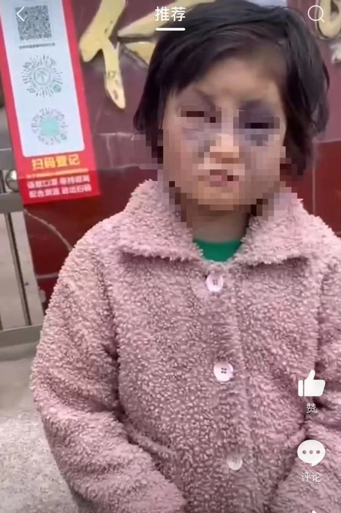 当地通报女童被打成熊猫眼：系精神残疾母亲所打女孩已出院
