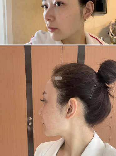 欧洲之星fotona4d 面部提升效果怎么样?_腾讯新闻