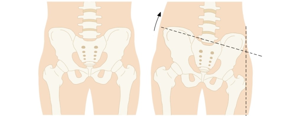 生完孩子这4种骨盆异常危害大你还觉得产后骨盆修复不重要吗